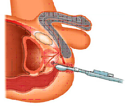 経直腸的前立腺生検