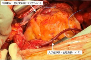 冠状動脈バイパス術