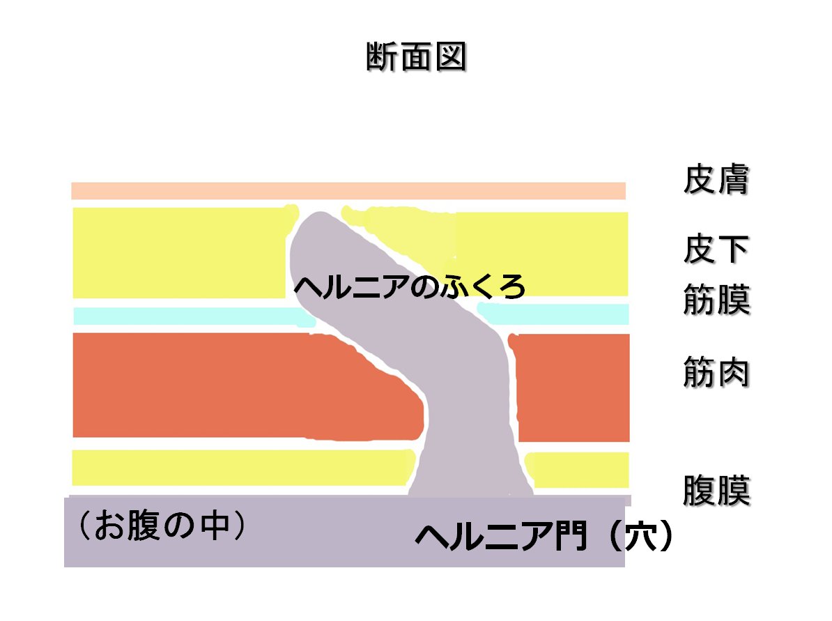 そけいヘルニア断面図