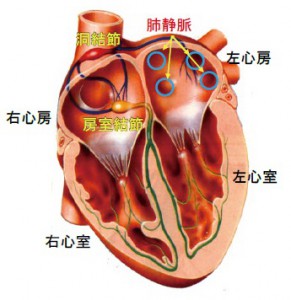 手術 動 心房 細 カテーテル治療 心房細動の（高周波心筋焼灼術）