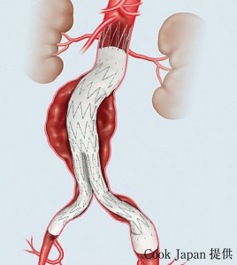 ステントグラフトを留置したイメージ