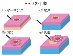 ESDの手順