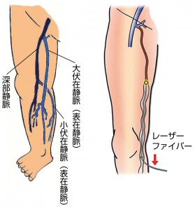 下肢静脈瘤血管内レーザー治療