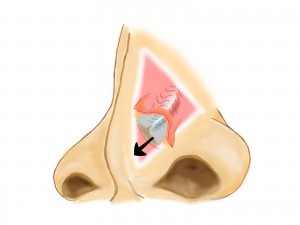鼻中隔矯正手術②