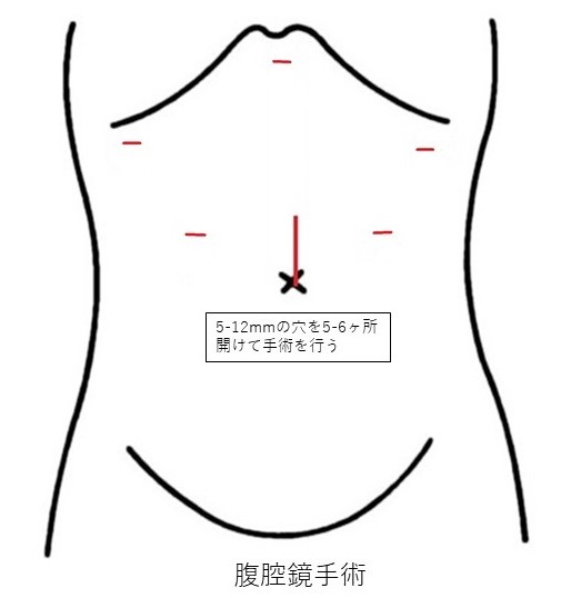 腹腔鏡手術